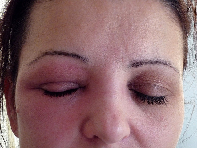 Apaiser les allergies