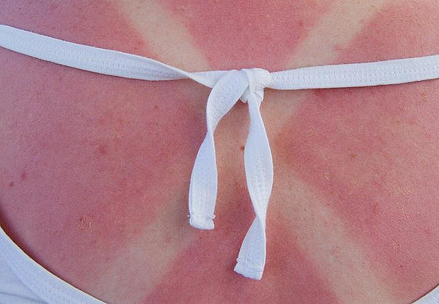 Remède contre le coup de soleil