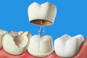 Recoller une couronne