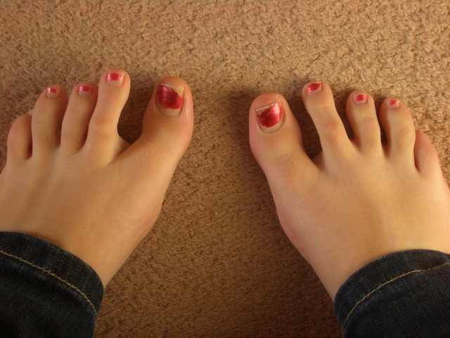 Soigner des verrues naturellement